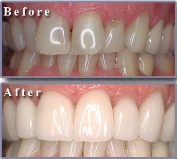 Зубы до (before) и после (after) реставрации зубов кеармическими винирами 